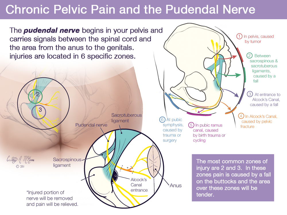Pudendal Neuralgia Treatment & Symptoms - WHRIA
