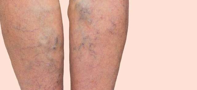 Blood Clots