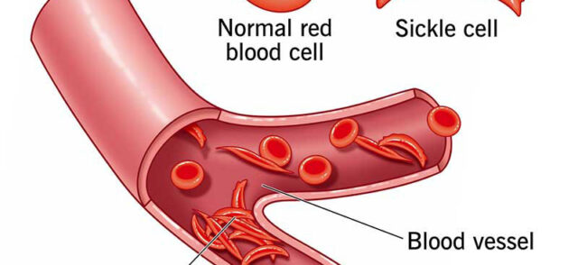 Sickle Cell Disease