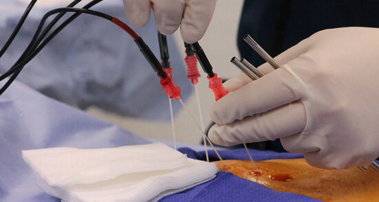 Radiofrequency Ablation/ ablación por radiofrecuencia