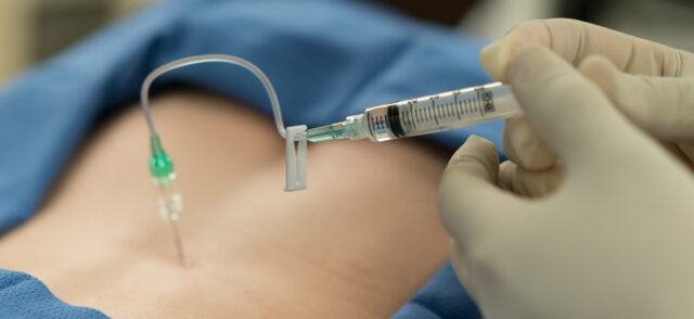 Selective Nerve Root Block/ Bloqueo Selectivo de la Raíz Nerviosa