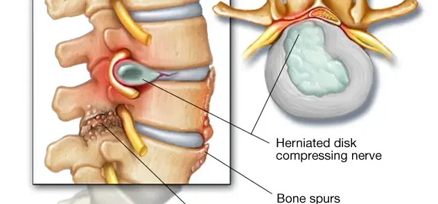 Spinal Stenosis/ Estenosis espinal